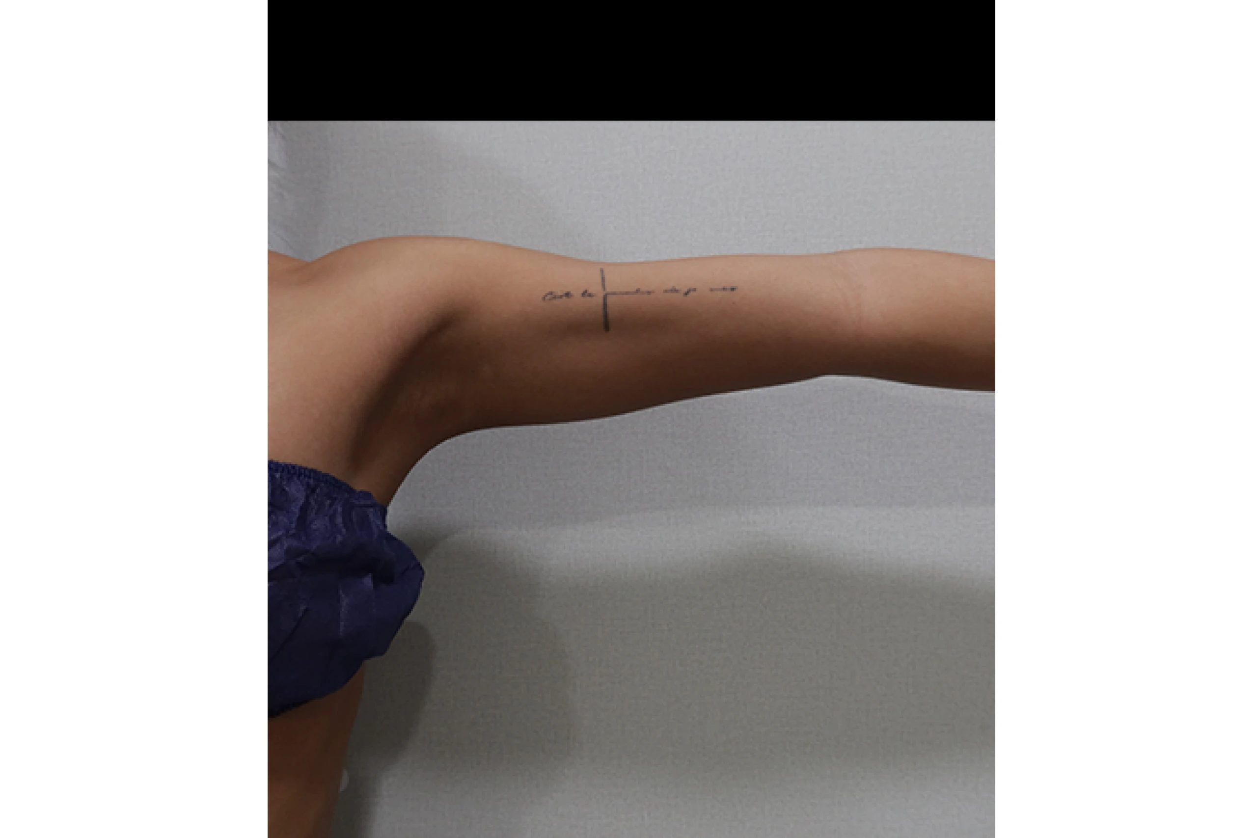 ボディチタンレーザー施術前の側面 04