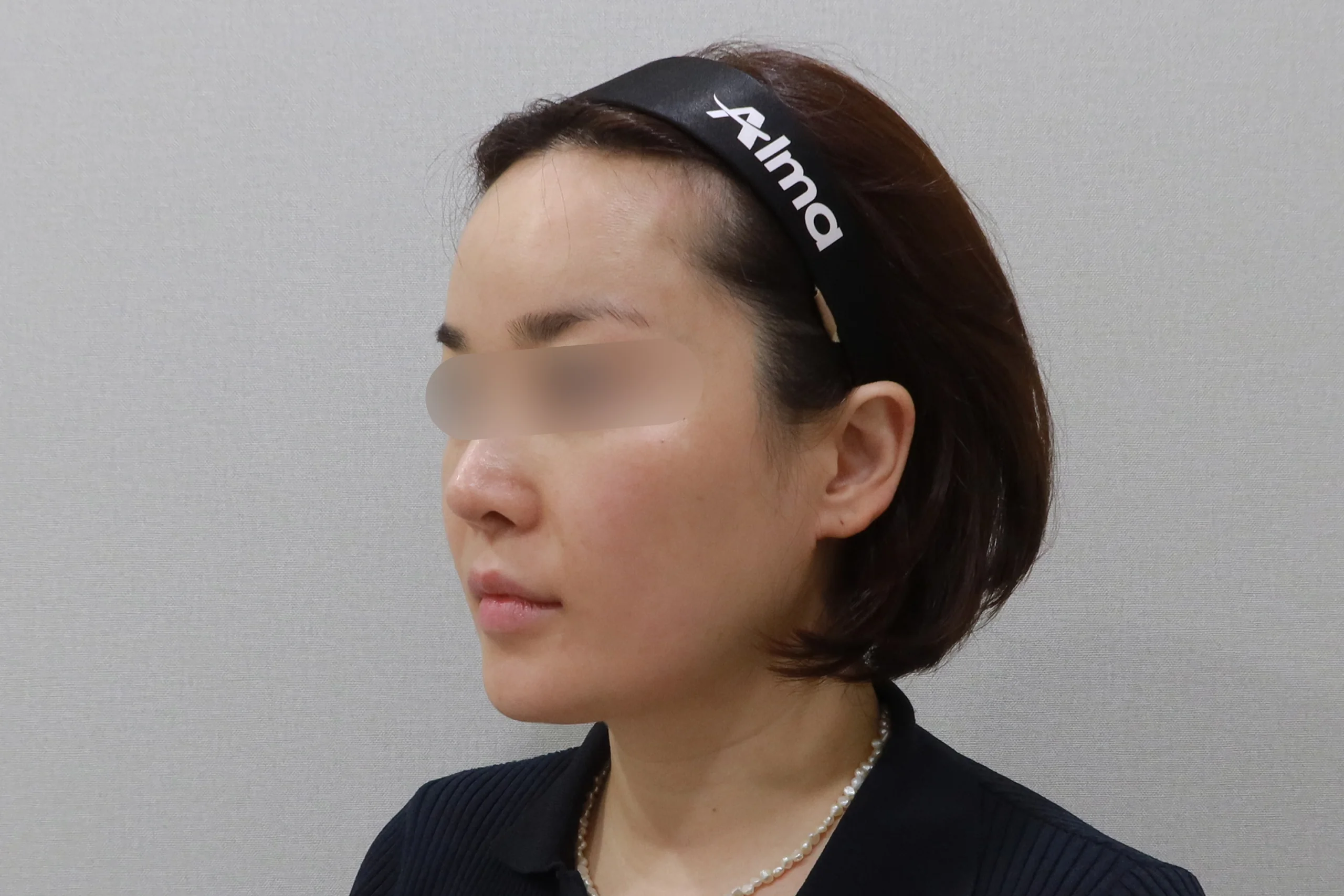 顔面消しゴム注射後の側面写真 4